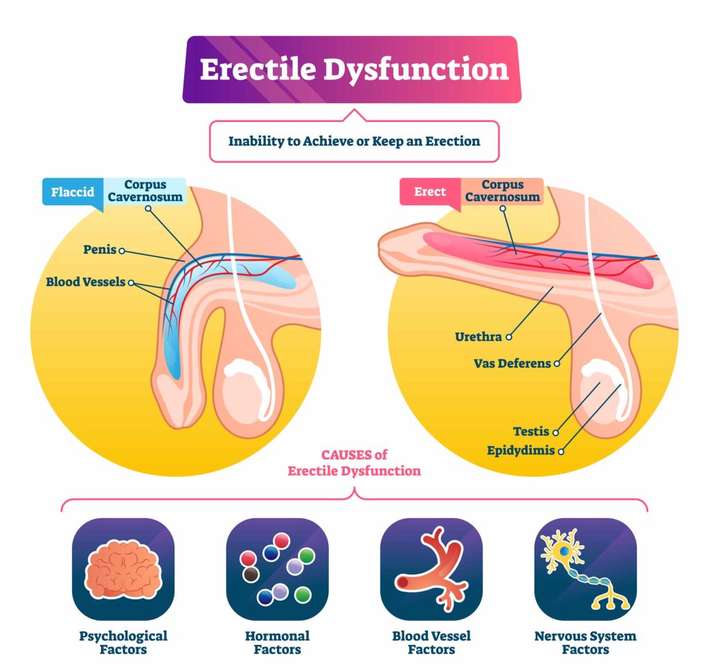 Erectile dysfunction homeopathy treatment in Lucknow