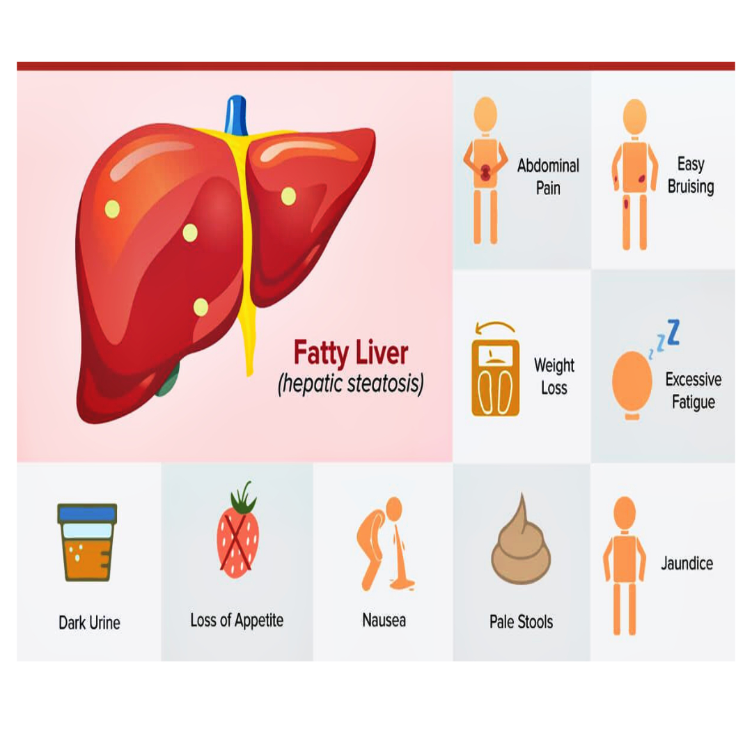 homeopathic-medicine-for-fatty-liver