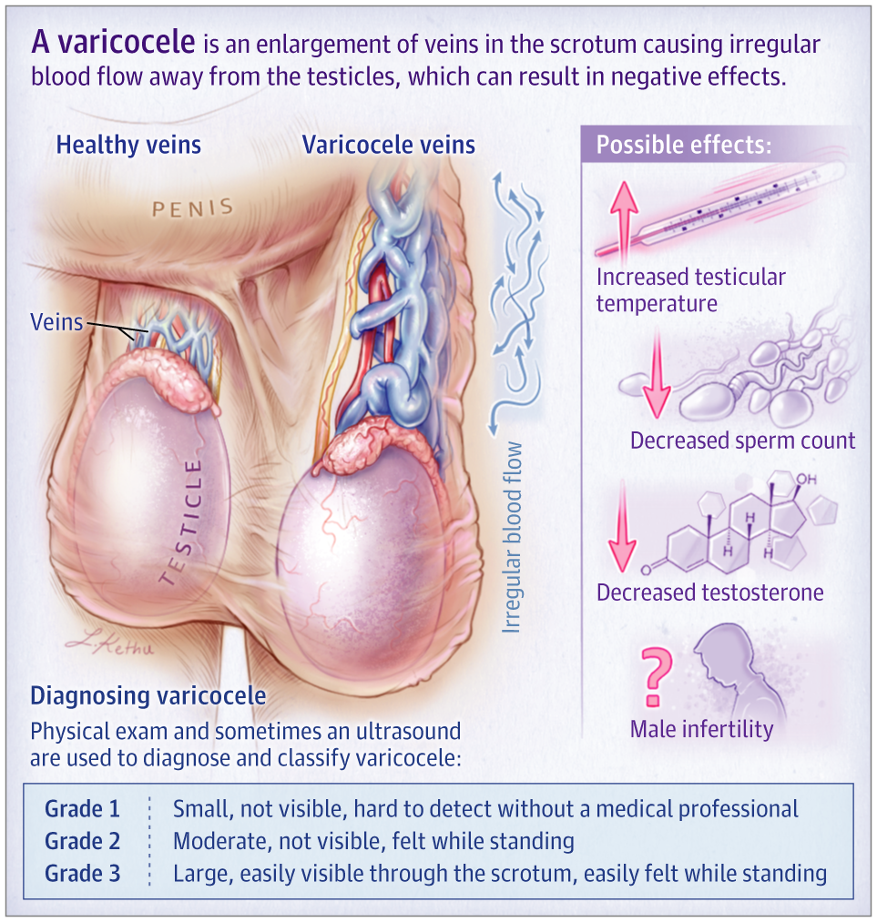 Varicocele - Causes, Symptoms & Treatment