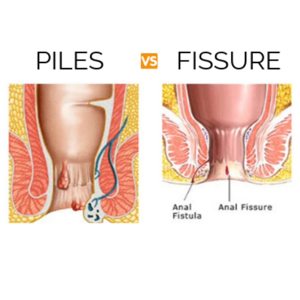 Difference between Piles and Fissure